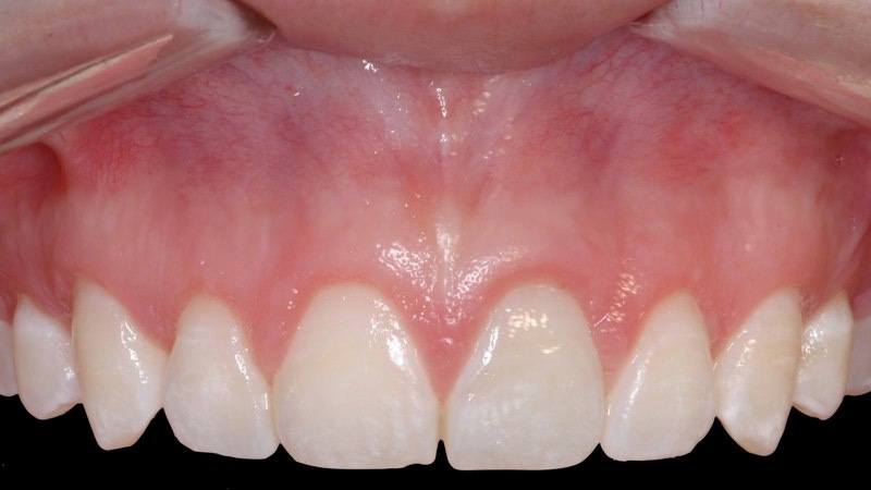 Closeup of smile after aesthetic gum recontouring