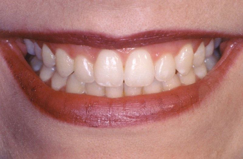 Closeup of smile with oversized front teeth