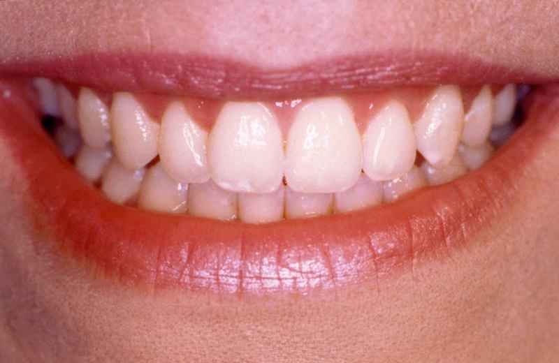 Closeup of smile after aesthetic gum recontouring