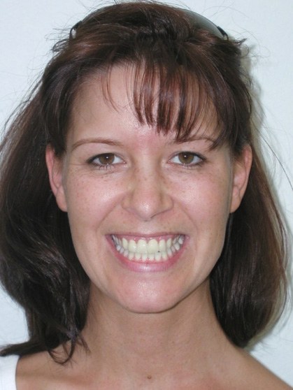 Patient smiling before aesthetic gum recontouring