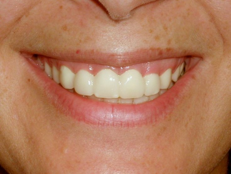 Closeup of smile before aesthetic gum recontouring