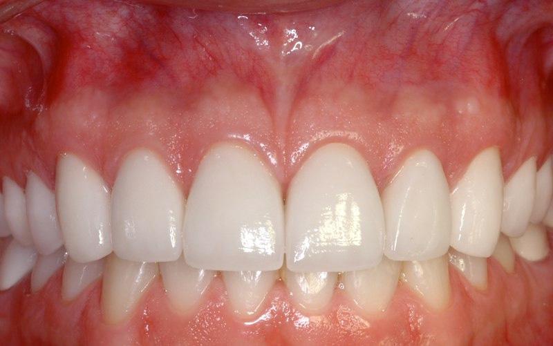 Closeup of smile after aesthetic gum recontouring