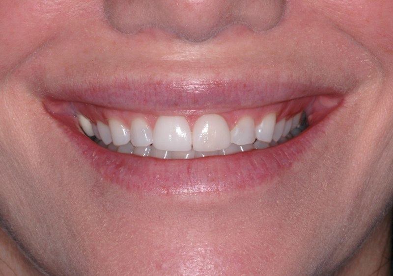 Closeup of smile before aesthetic gum recontouring