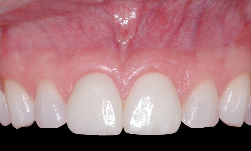 Closeup of smile after aesthetic gum recontouring