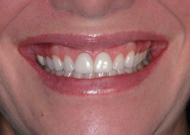 Patient's smile after aesthetic gum recontouring