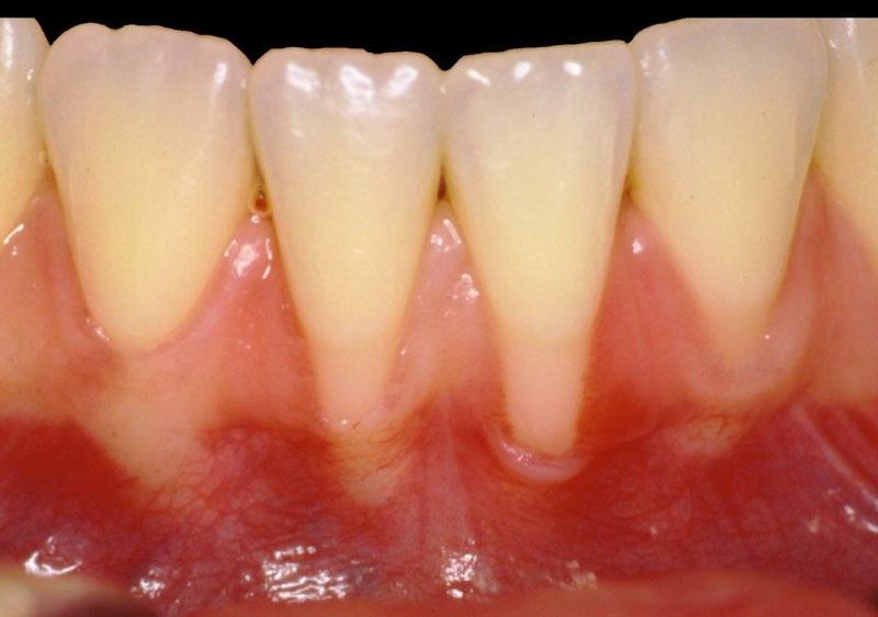 Smile with tooth roots visible below thing gum tissue