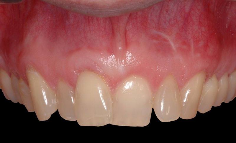 Smile after gum grafting and orthodontics