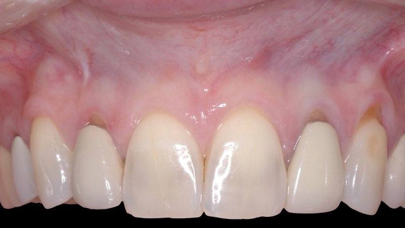 Smile six months after gum grafting