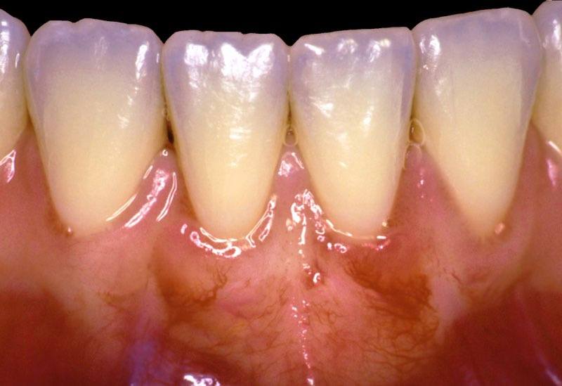 Smile with improved gum tissue coverage six months after gum grafting