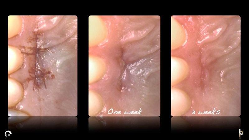 Three images of smile at various stages of the gum grafting and healing process