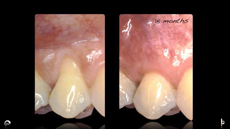 Image of recessed gum tissue and the patient's healthy smile 15 months after treatment