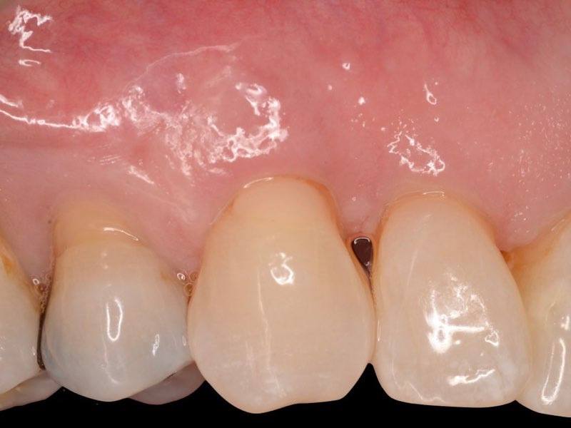 Tooth root concealed after gum grafting