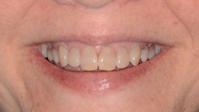 Patient's smile after gum grafting treatment