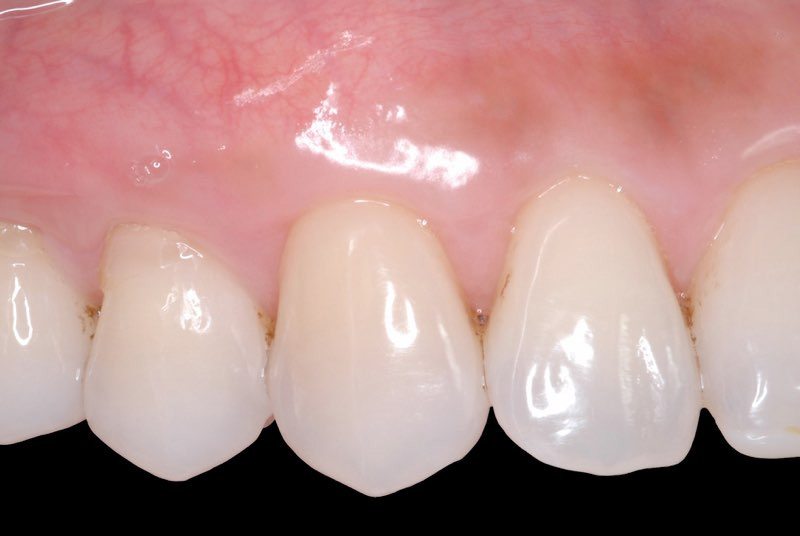 Smile with even gum line after grafting procedure