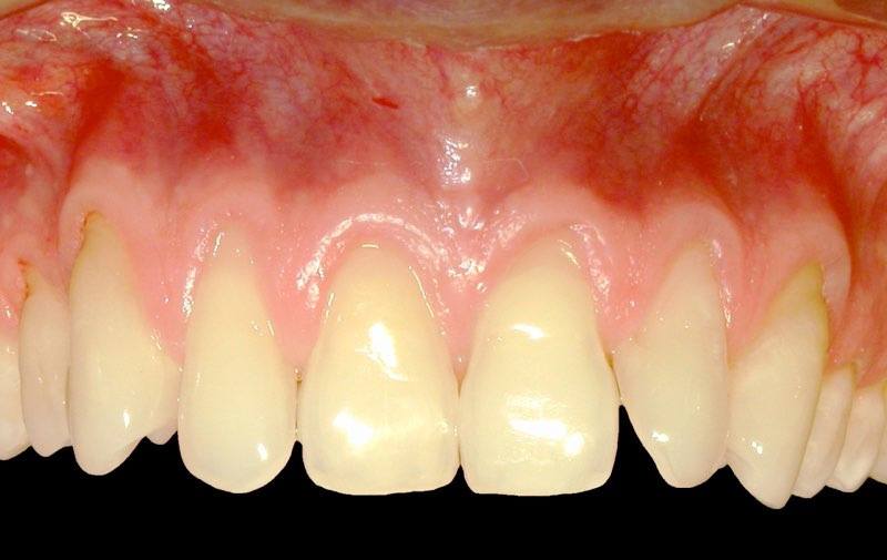 Smile with red and inflamed gum tissue
