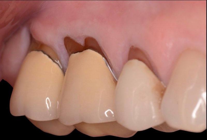 Severe gum tissue recession with tooth roots visible