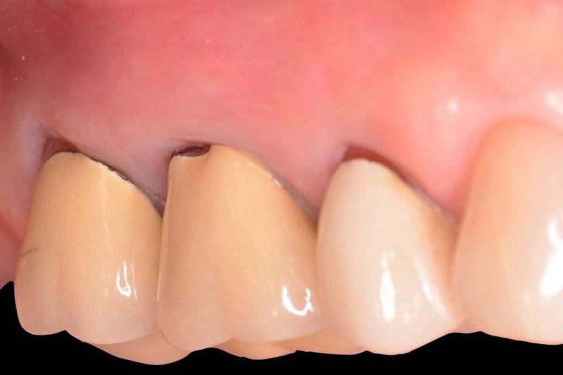 Smile with roots concealed after gum grafting