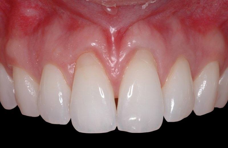 Smile with of tissue recession before emdogain gum grafting treatment