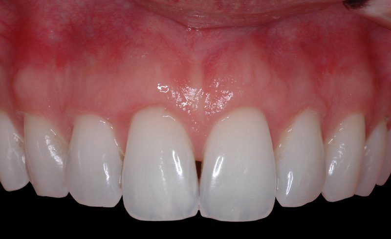 Patient's smile after gum grafting