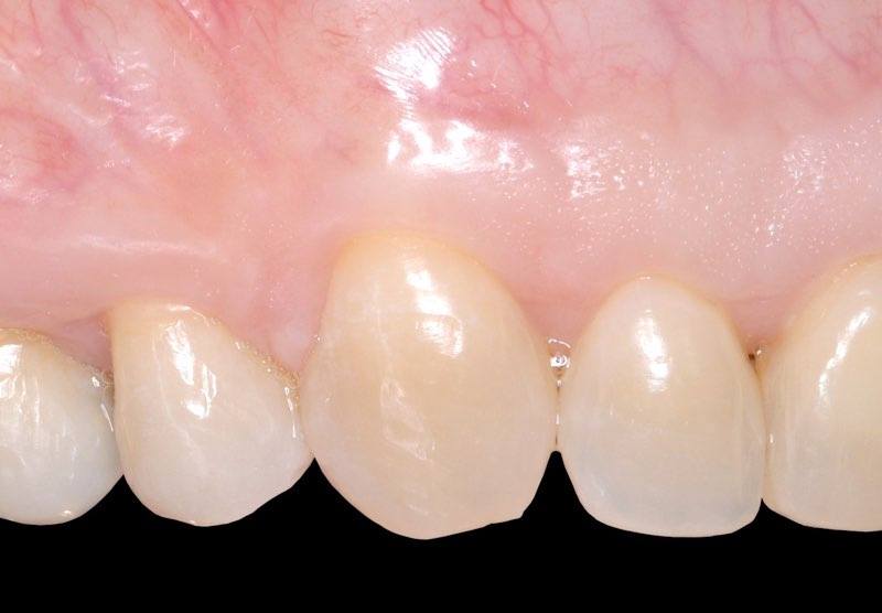 Healthy smile after gum tissue grafting