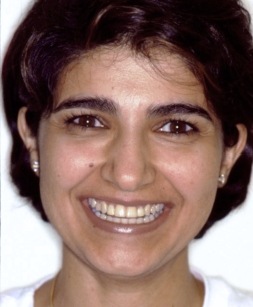 Patient sharing gorgeous smile after dental implant tooth replacement