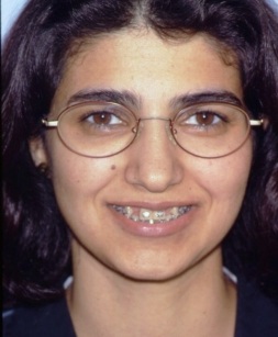 Patient with missing teeth before dental implant tooth replacement