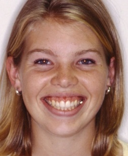 Young woman with beautiful smile after cosmetic gum treatment