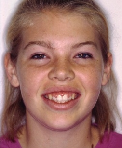 Young woman with uneven gum line