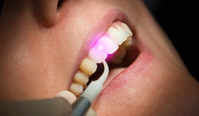 Patient receiving soft tissue laser dentistry treatment