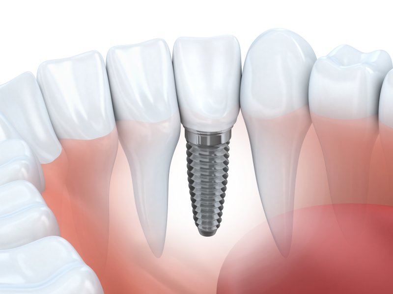 Diagram of a dental implant in San Antonio