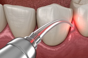 Digital image of laser gum recontouring 