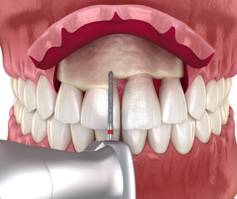 Illustration of a crown lengthening procedure including the bone