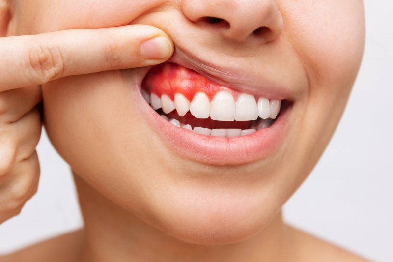 A woman revealing her inflamed and infected gums