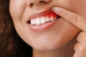 Woman with gingivitis